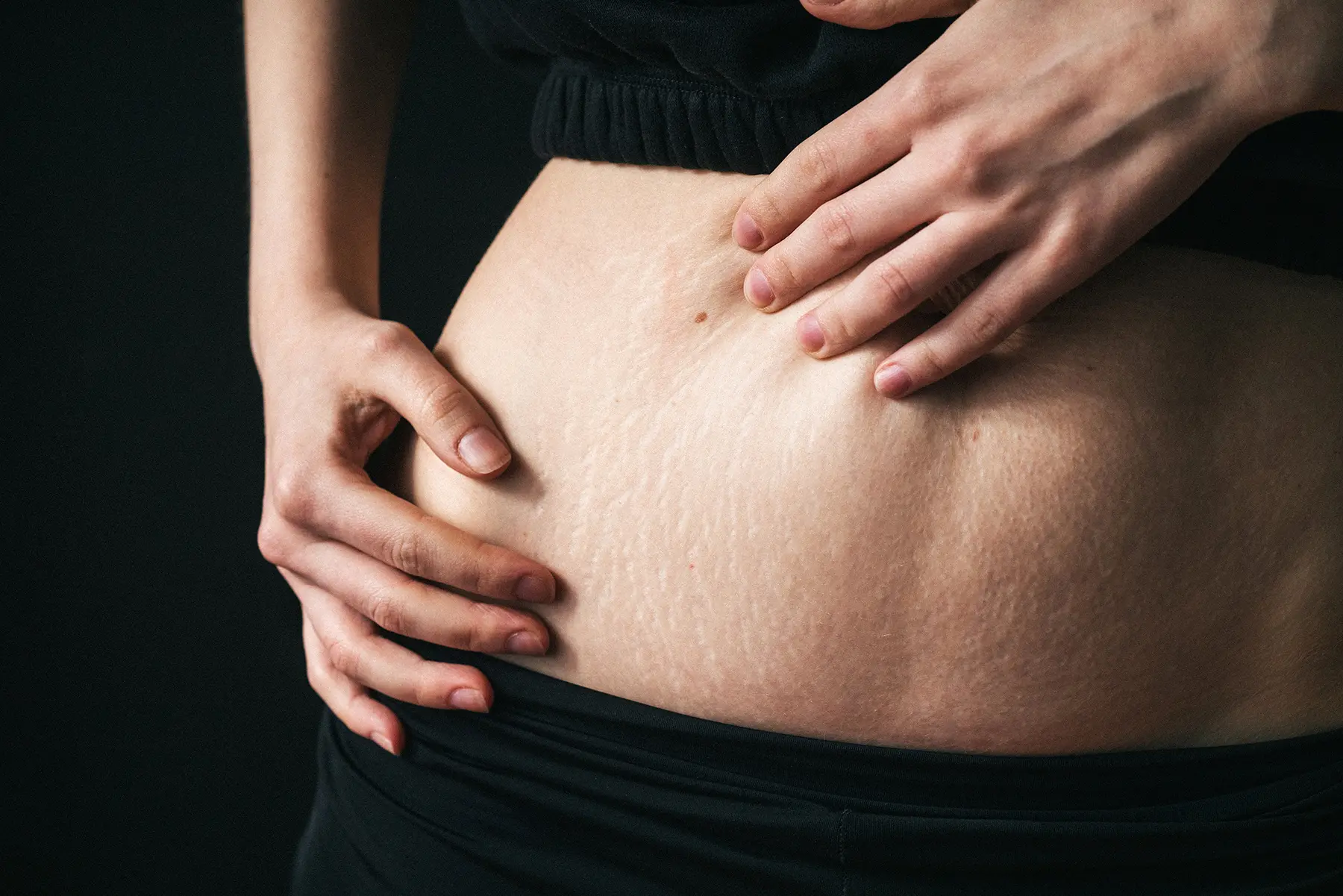 Erase Stretch Marks With These Innovative Treatments