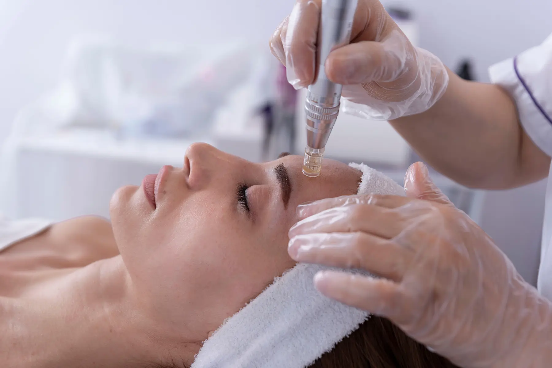 10 Incredible Benefits of RF Microneedling