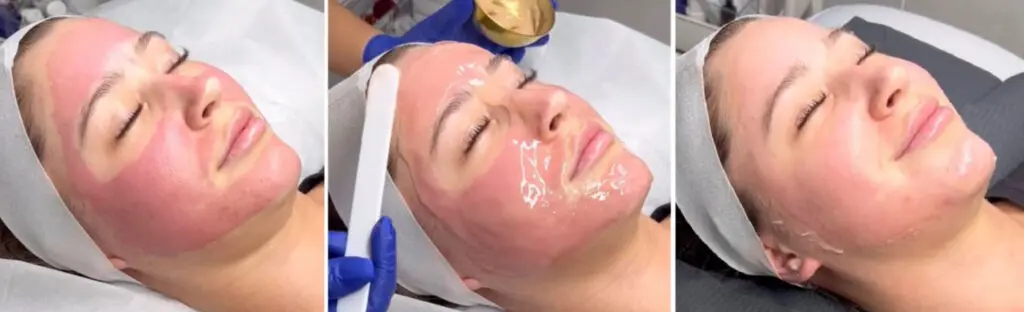 Microneedling with PRP