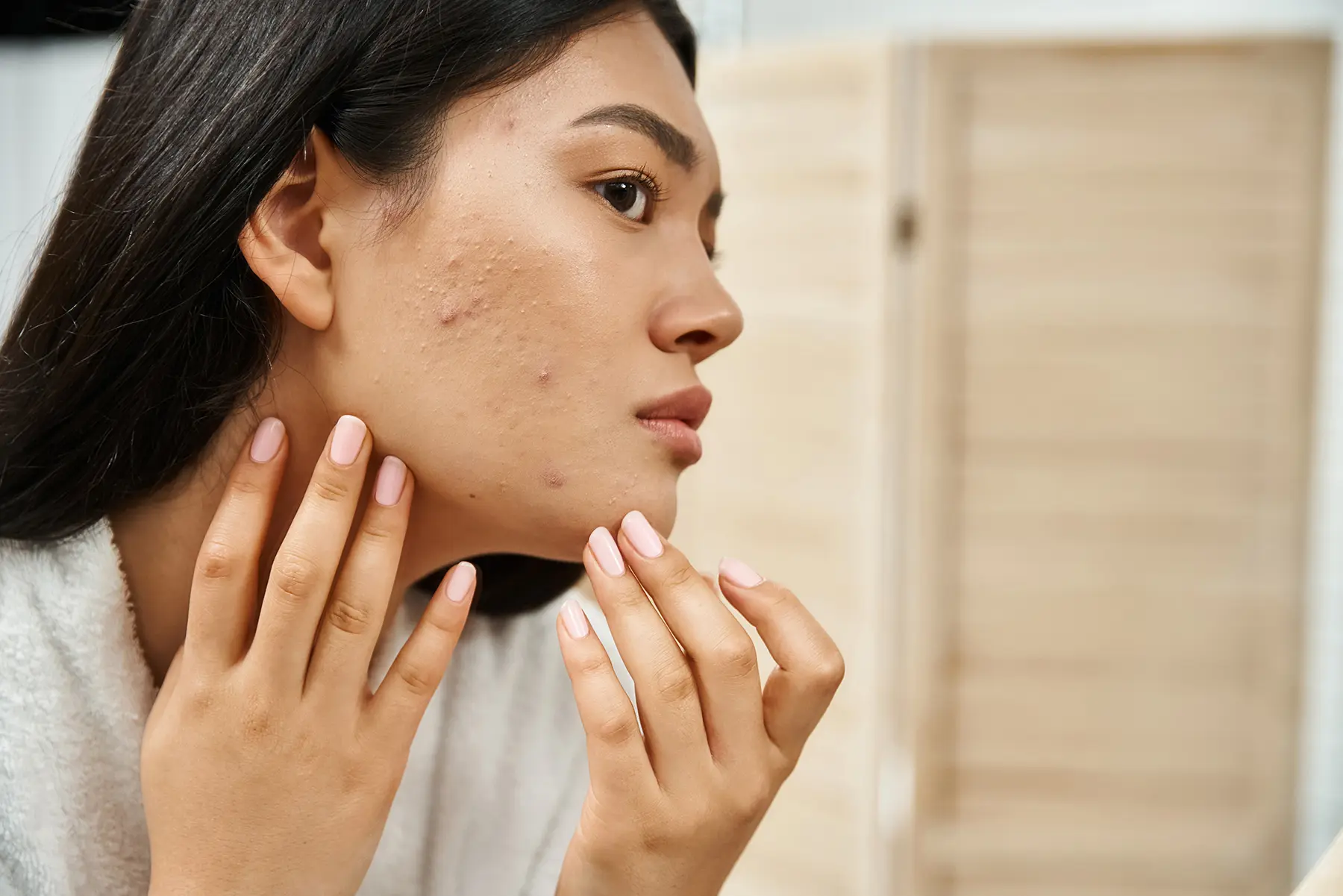Smooth Your Skin Naturally: PRP + Microneedling for Stubborn Acne Scars