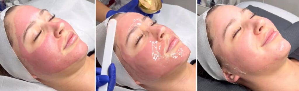 Microneedling with PRP
