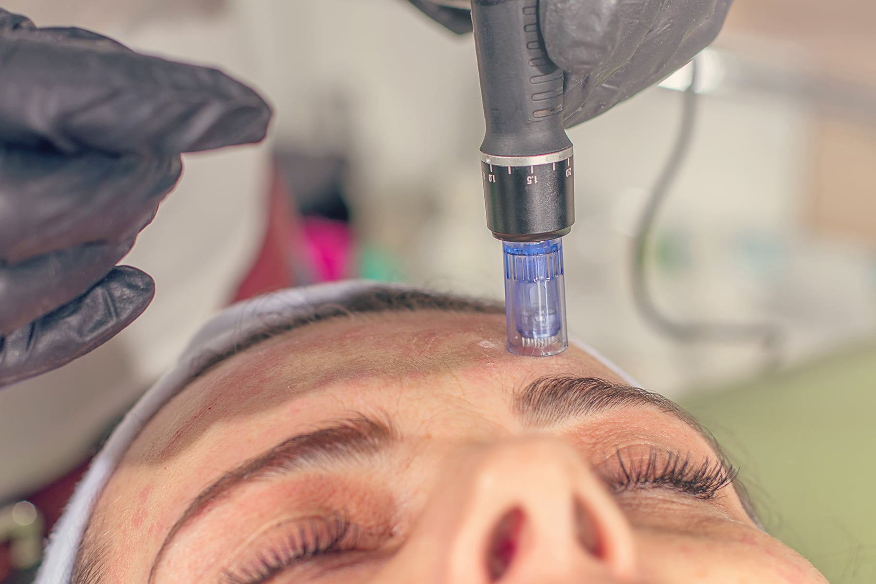 Microneedling Before and After: What Changes Can You Expect?
