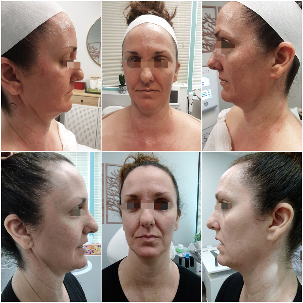 Before and aftermicroneedling