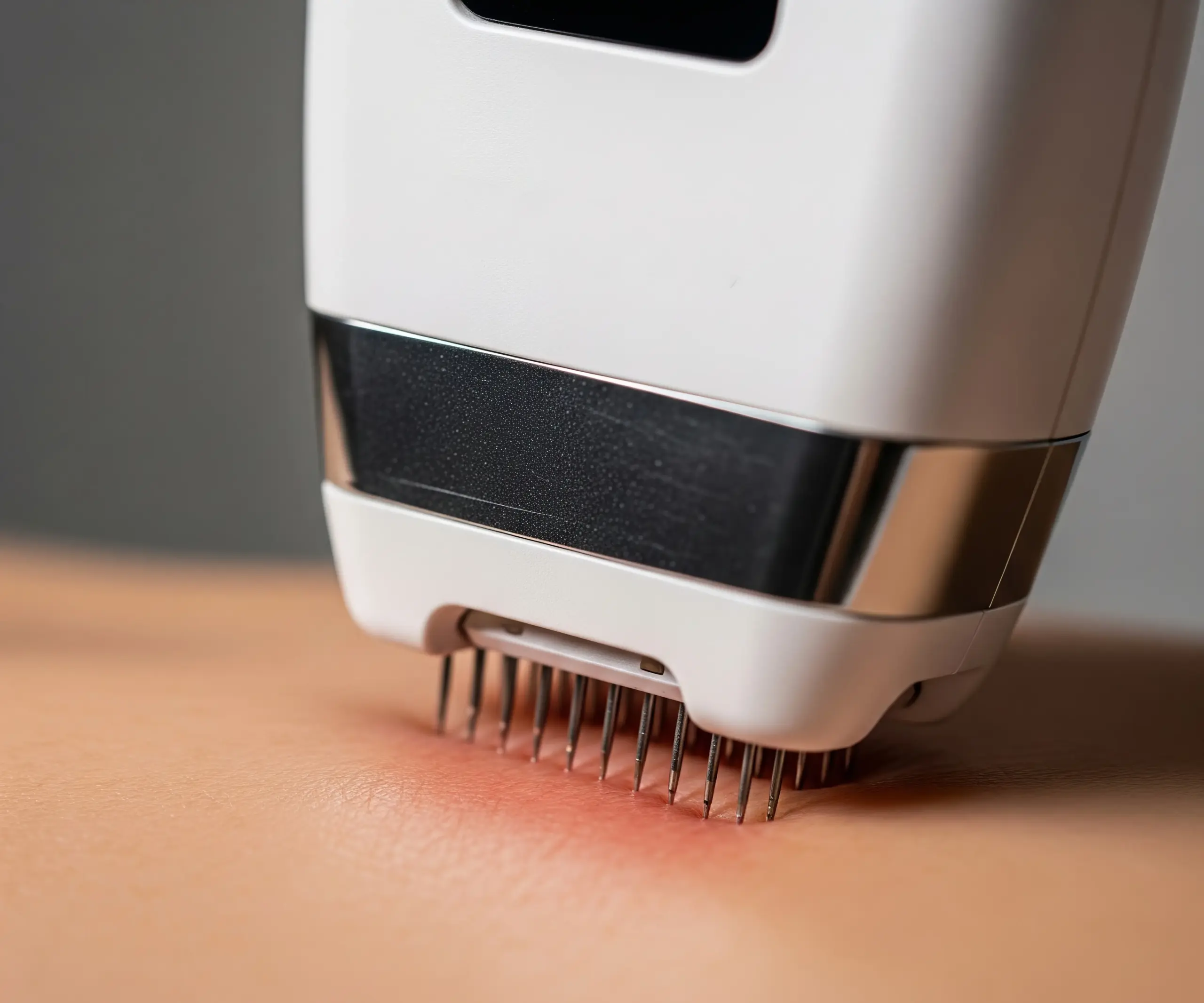RF microneedling treatment for stretch marks being performed on a patient's skin