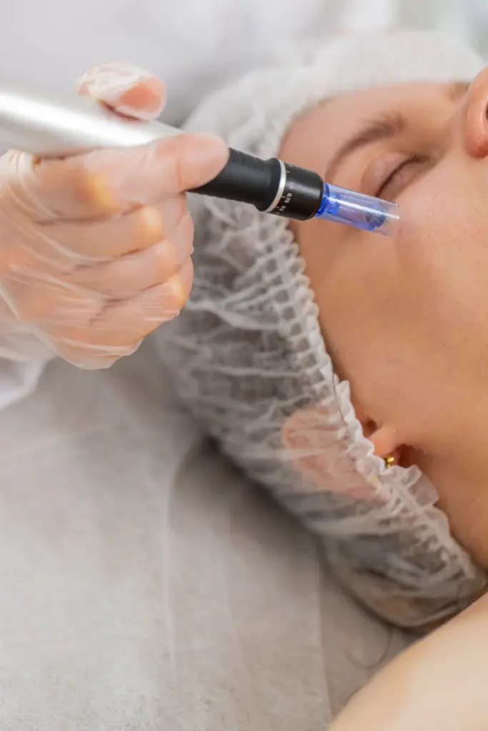 Gloved clinician guiding a microneedling pen with a blue needle cartridge along a patient's temple during a collagen treatment.