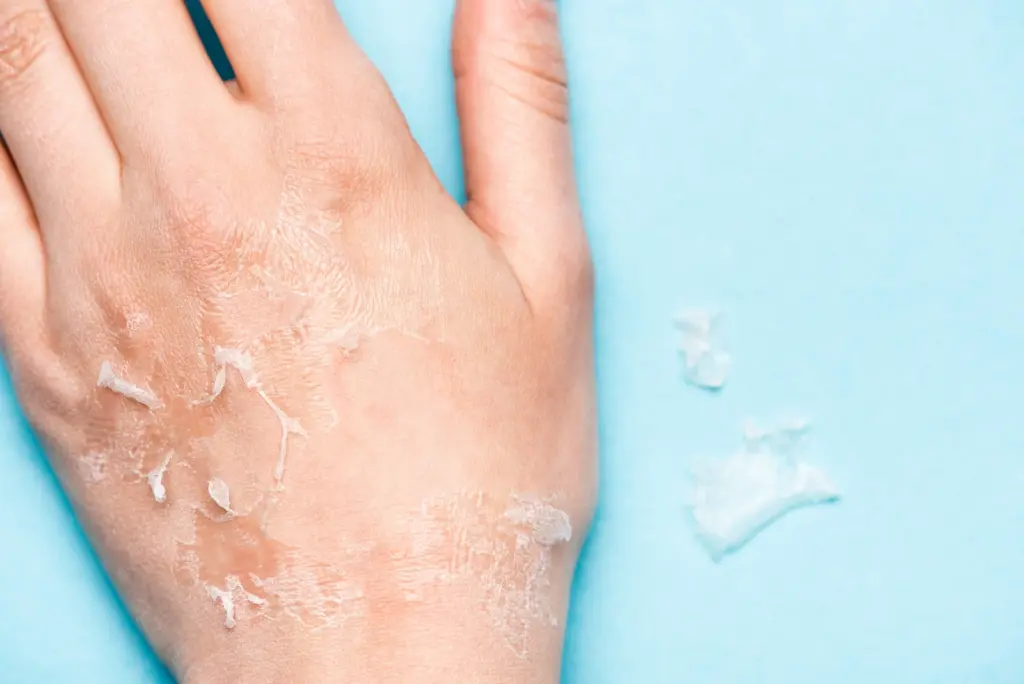 Close up of a hand with dry, peeling skin against a blue background, a sign of a weakened skin barrier in the dry Arizona climate.