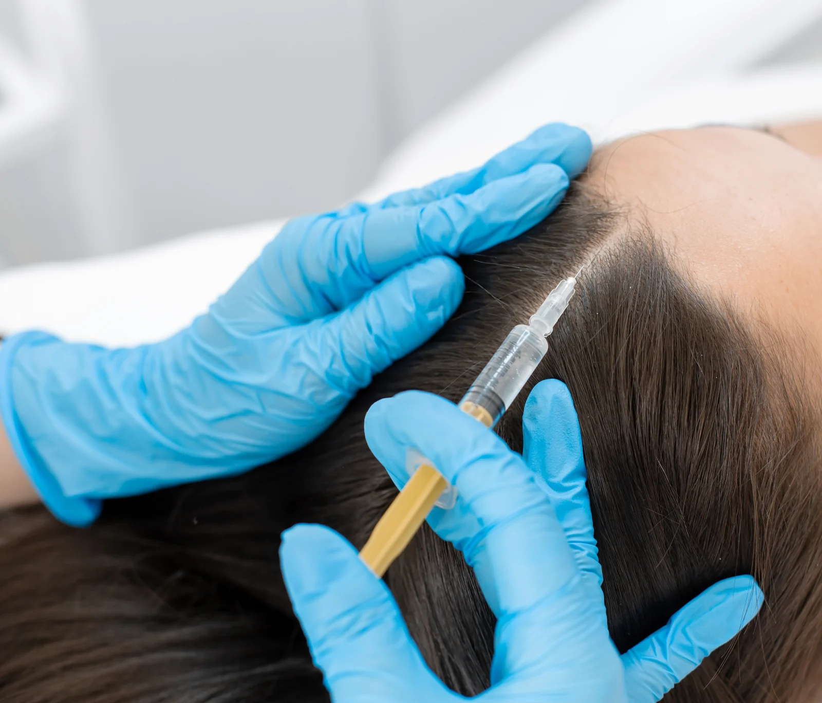 Gloved hands of a provider placing a PRP injection along a patient's hair part during a natural hair loss treatment in South Tempe, AZ.