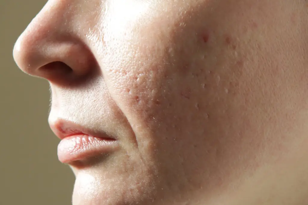 Close up of a cheek with shallow acne scars, enlarged pores and uneven texture, concerns RF microneedling is used to treat in Tempe.